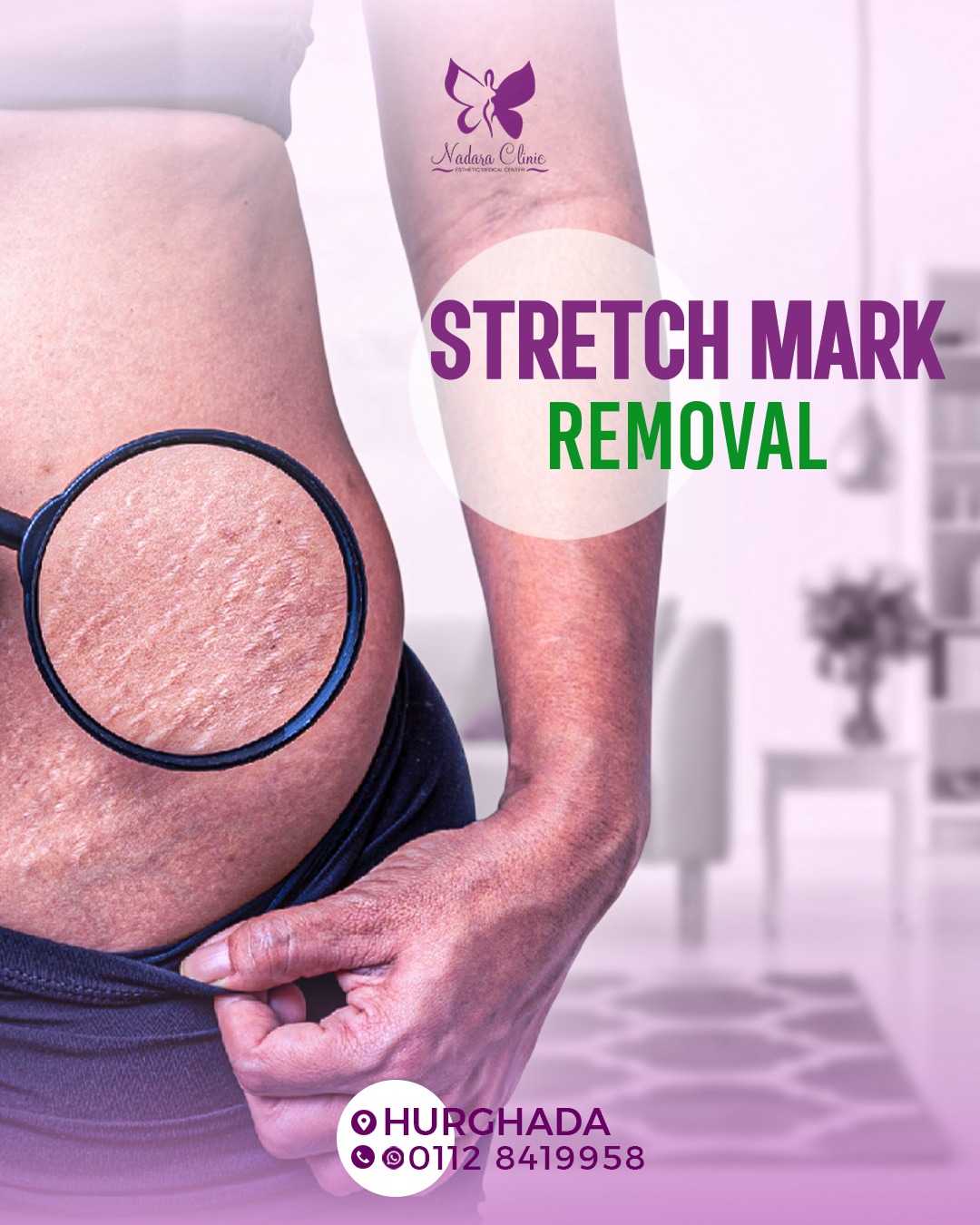 Causes of stretch marks and ways to treat them